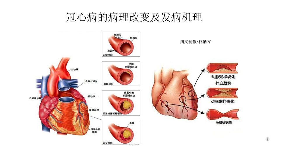 冠心病是什么病图片